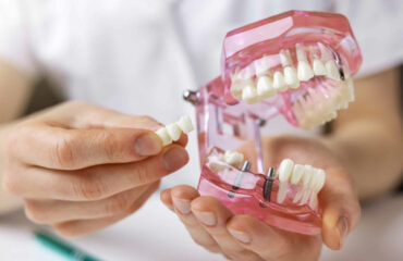 colocação de implante dentário