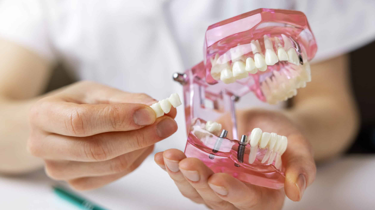 colocação de implante dentário
