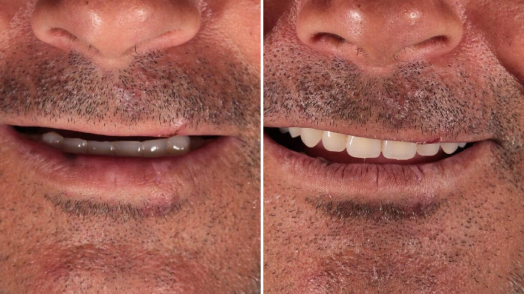 implante dentário antes e depois
